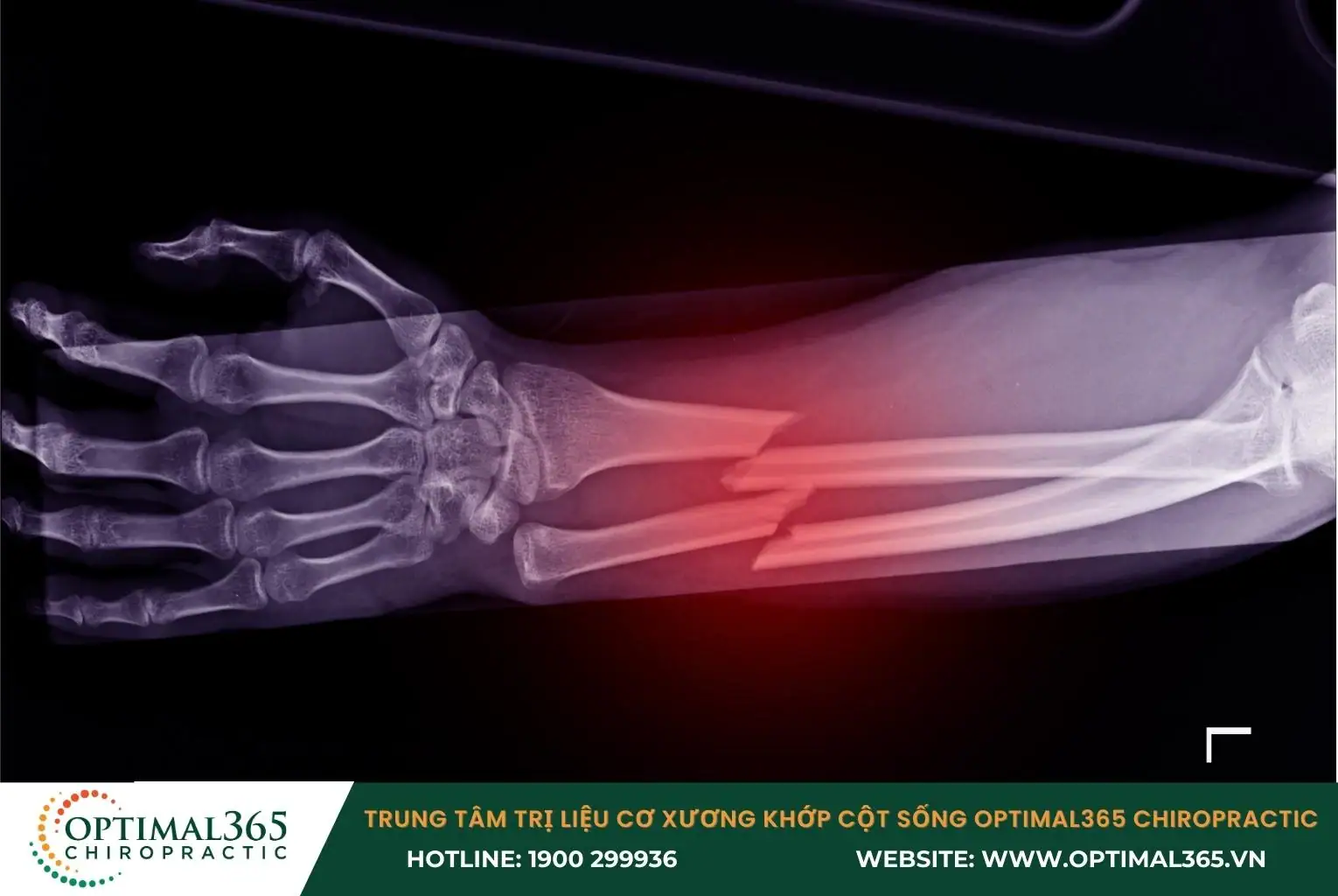 Gãy xương thường do bị chấn thương hoặc bệnh lý