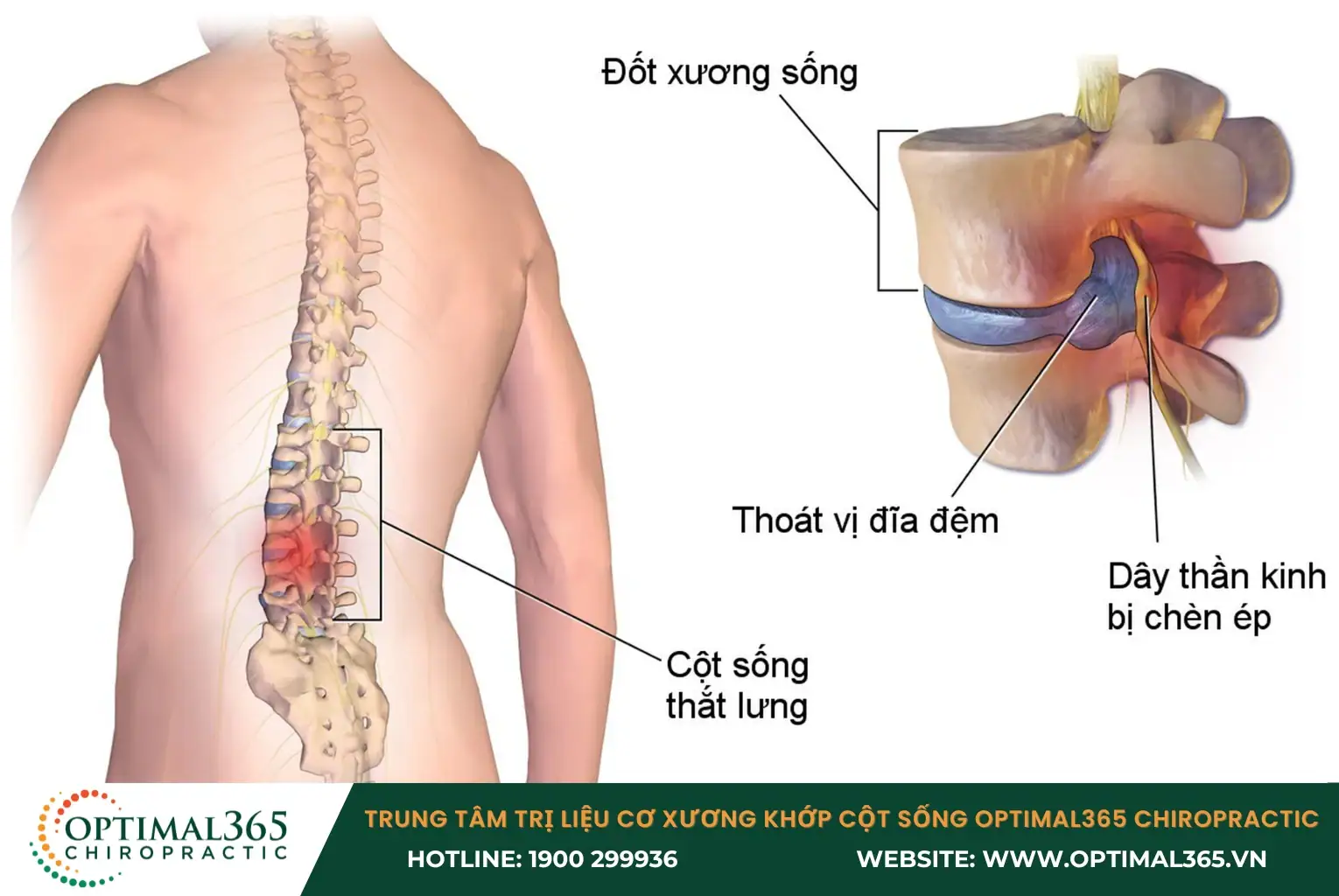 Thoát vị đĩa đệm cột sống thường xảy ra ở thắt lưng hoặc cổ