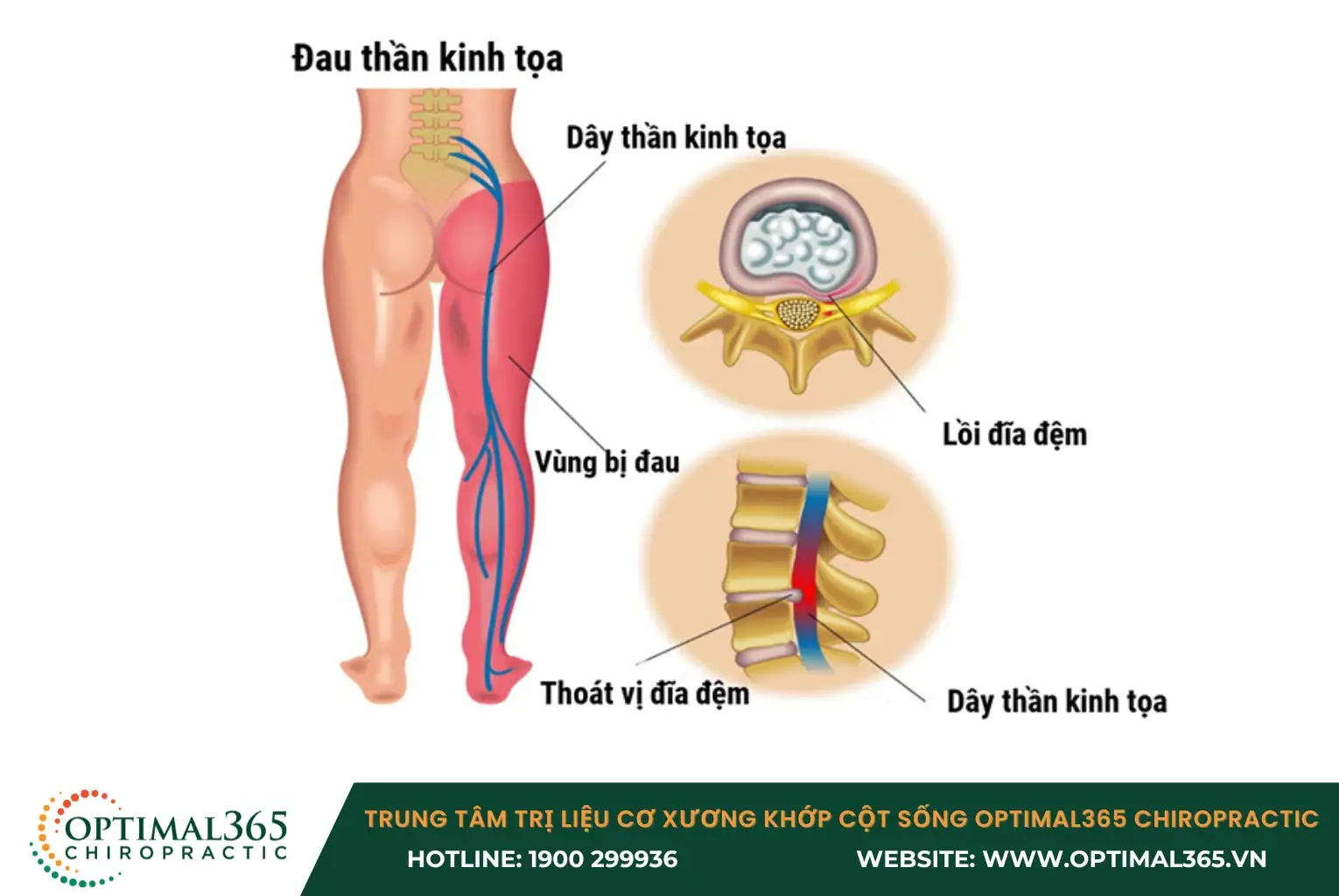 Đau dây thần kinh tọa có biểu hiện đau âm ỉ, tê nóng, như kiến bò