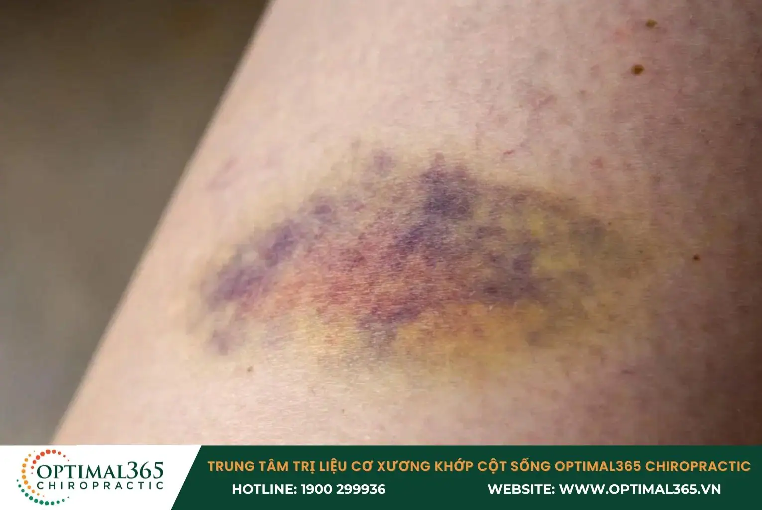 Các mạch máu nhỏ bị vỡ gây ra tình trạng xuất huyết dưới da, tạo thành các vết bầm tím