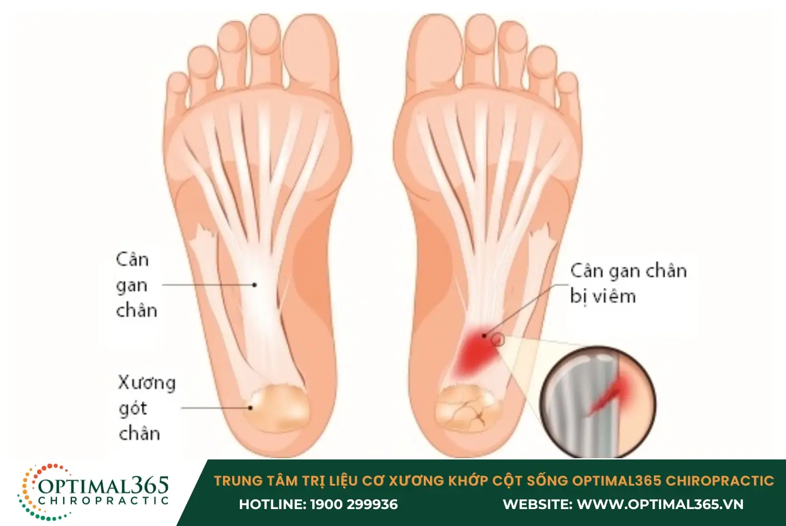 Nếu cầu thủ không khởi động kỹ trước khi thi đấu thì rất dễ bị viêm gan chân