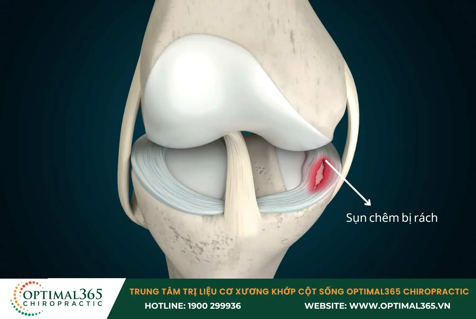 Rách sụn chêm gối có thể gặp phải khi cầu thủ xoay gối đột ngột