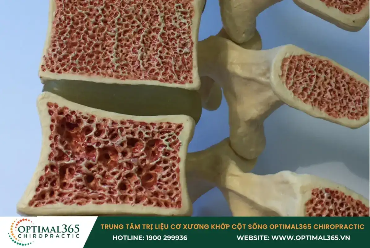 Loãng xương khiến các xương yếu và dễ tổn thương hơn