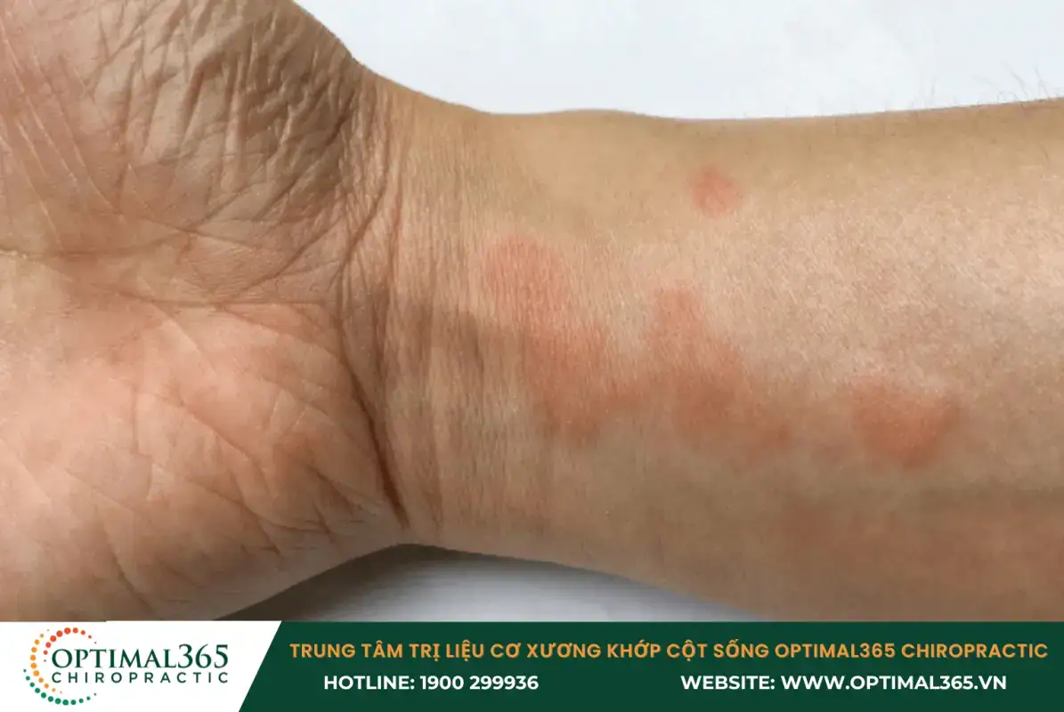 Bệnh Lupus ban đỏ là nguyên nhân gây đau và sưng khớp