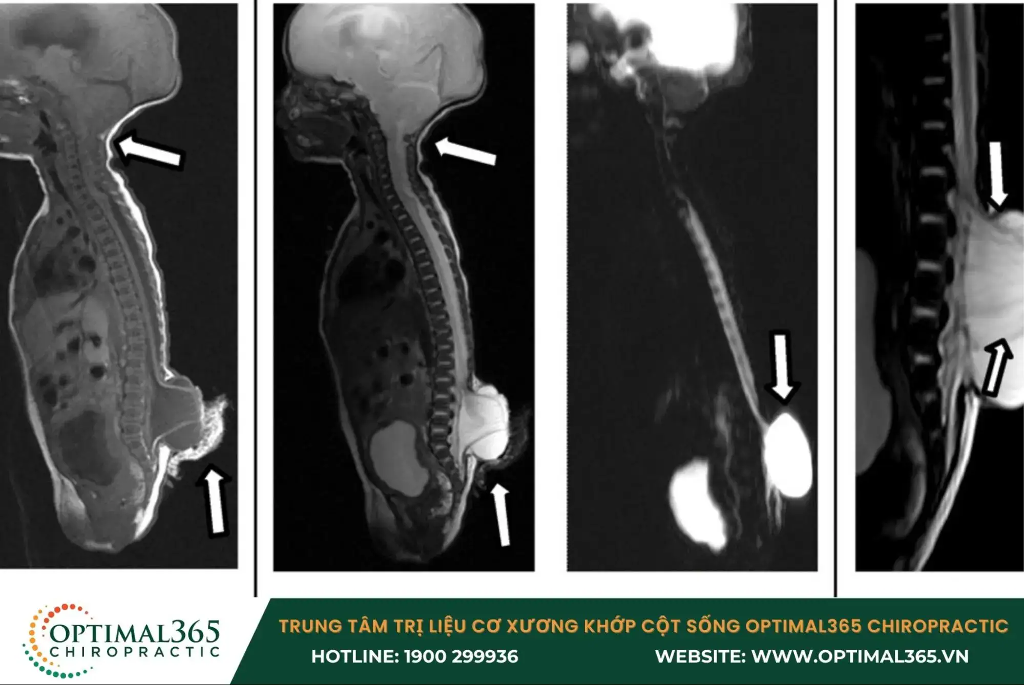 Chẩn đoán hình ảnh chuyên sâu để phát hiện bệnh gai đôi cột sống bẩm sinh