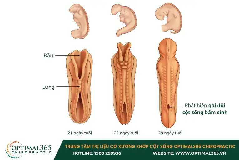 Gai đôi cột sống bẩm sinh xuất hiện trong quá trình phát triển thai nhi