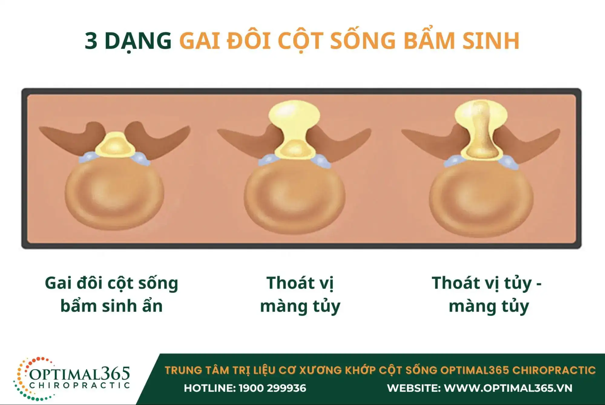 3 dạng gai đôi cột sống bẩm sinh ở thai nhi