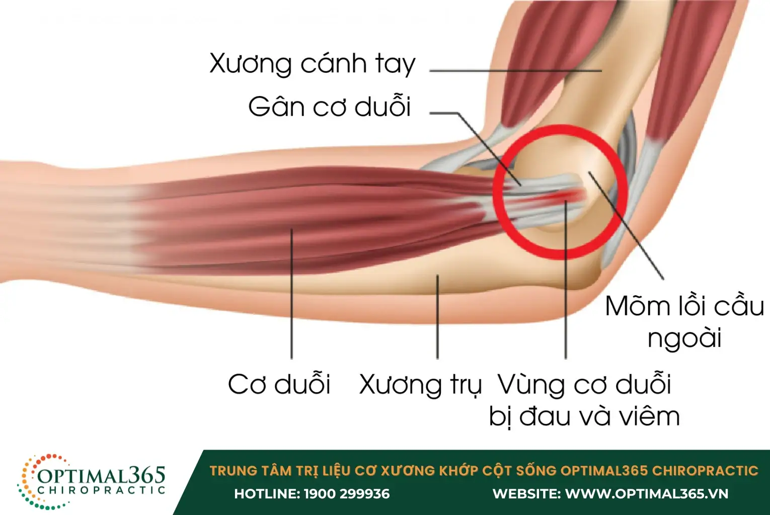 Nếu không điều trị kịp thời, viêm có thể trở thành viêm gân mãn tính