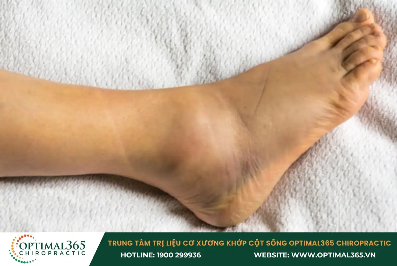 Khi bị chấn thương, các mạch máu nhỏ dưới da bị vỡ gây nên vết bầm tím