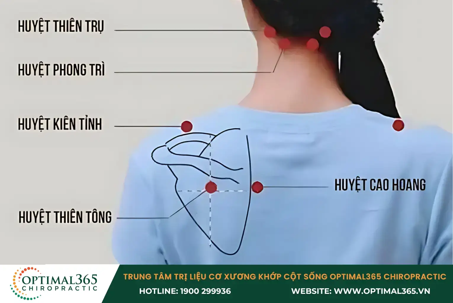 Các huyệt đạo châm cứu chữa đau vai gáy như huyệt phong trì, huyệt kiên tỉnh, huyệt thiên tông,...