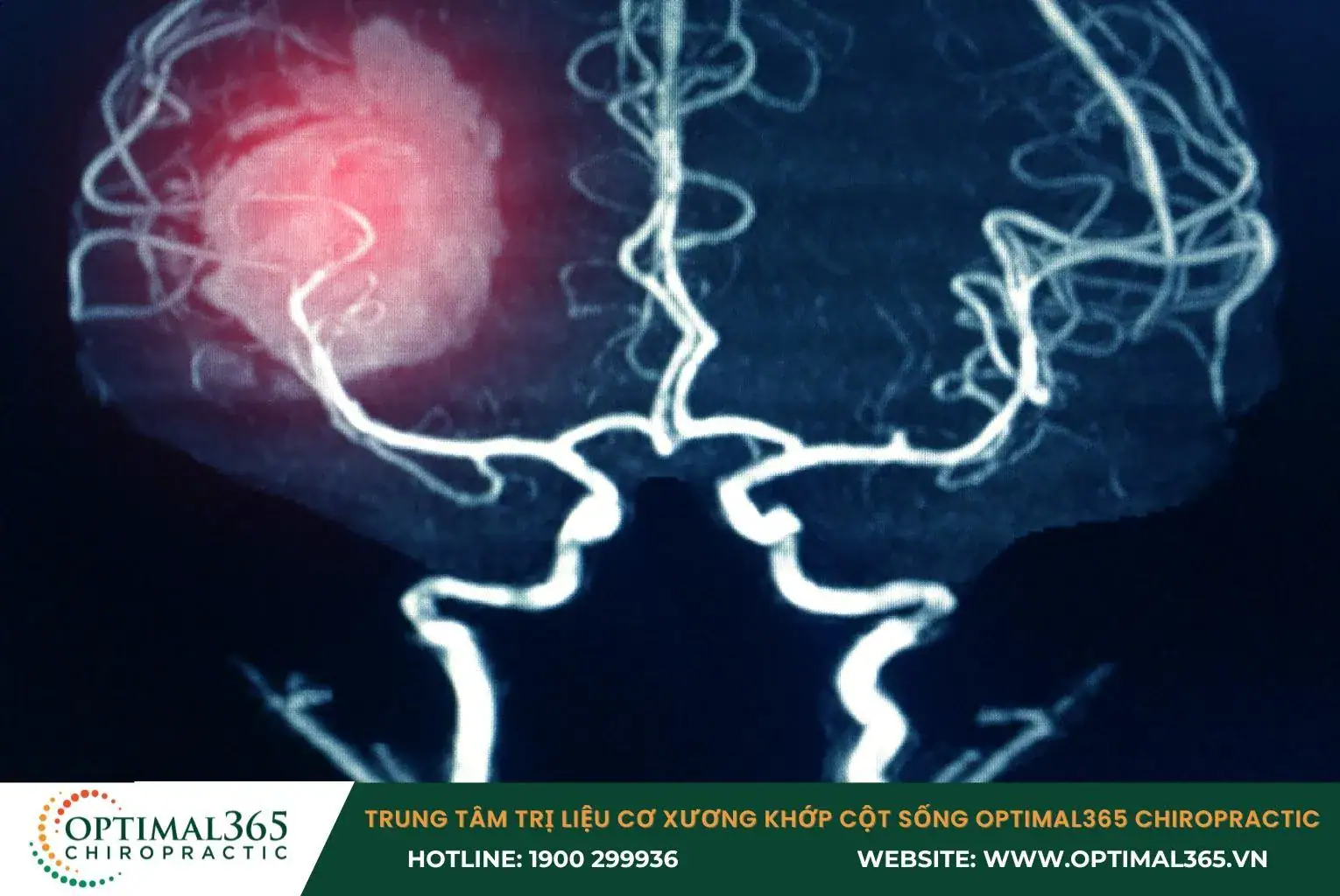 Xuất huyết não gây cơn đau đỉnh đầu, buồn nôn, hôn mê