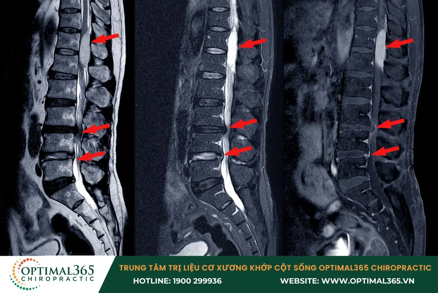 Hẹp ống sống có thể do thoái hóa đốt sống hoặc chấn thương