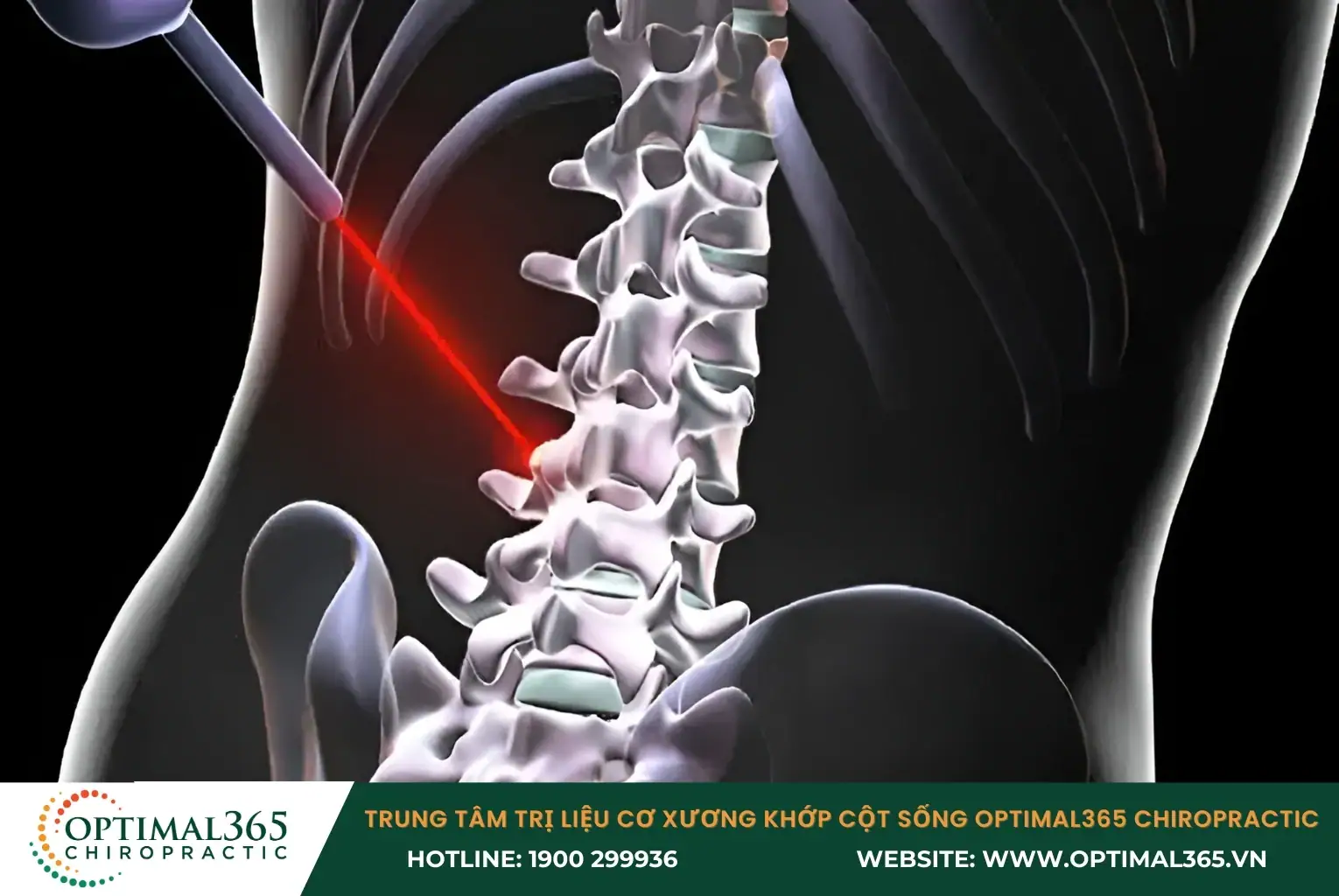 Mổ cột sống bằng tia laser giúp giảm áp lực lên dây thần kinh và loại bỏ phần xương bị tổn thương