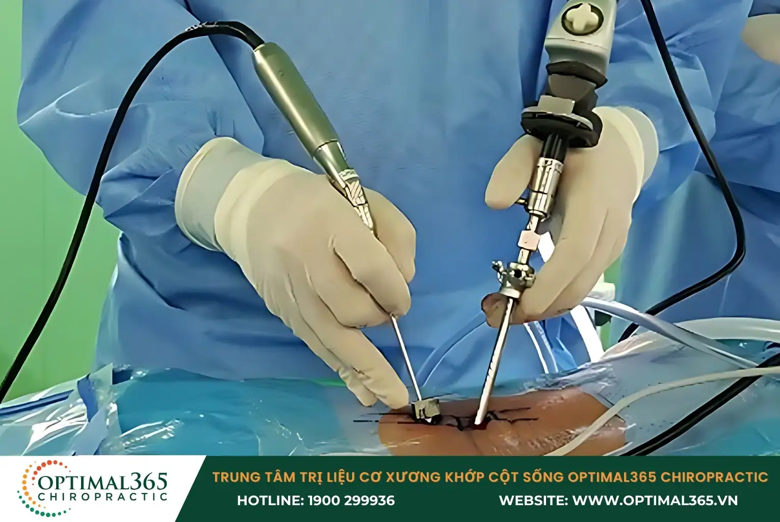 Mổ nội soi cột sống là phương pháp phẫu thuật ít xâm lấn dùng điều trị các vấn đề đến cột sống