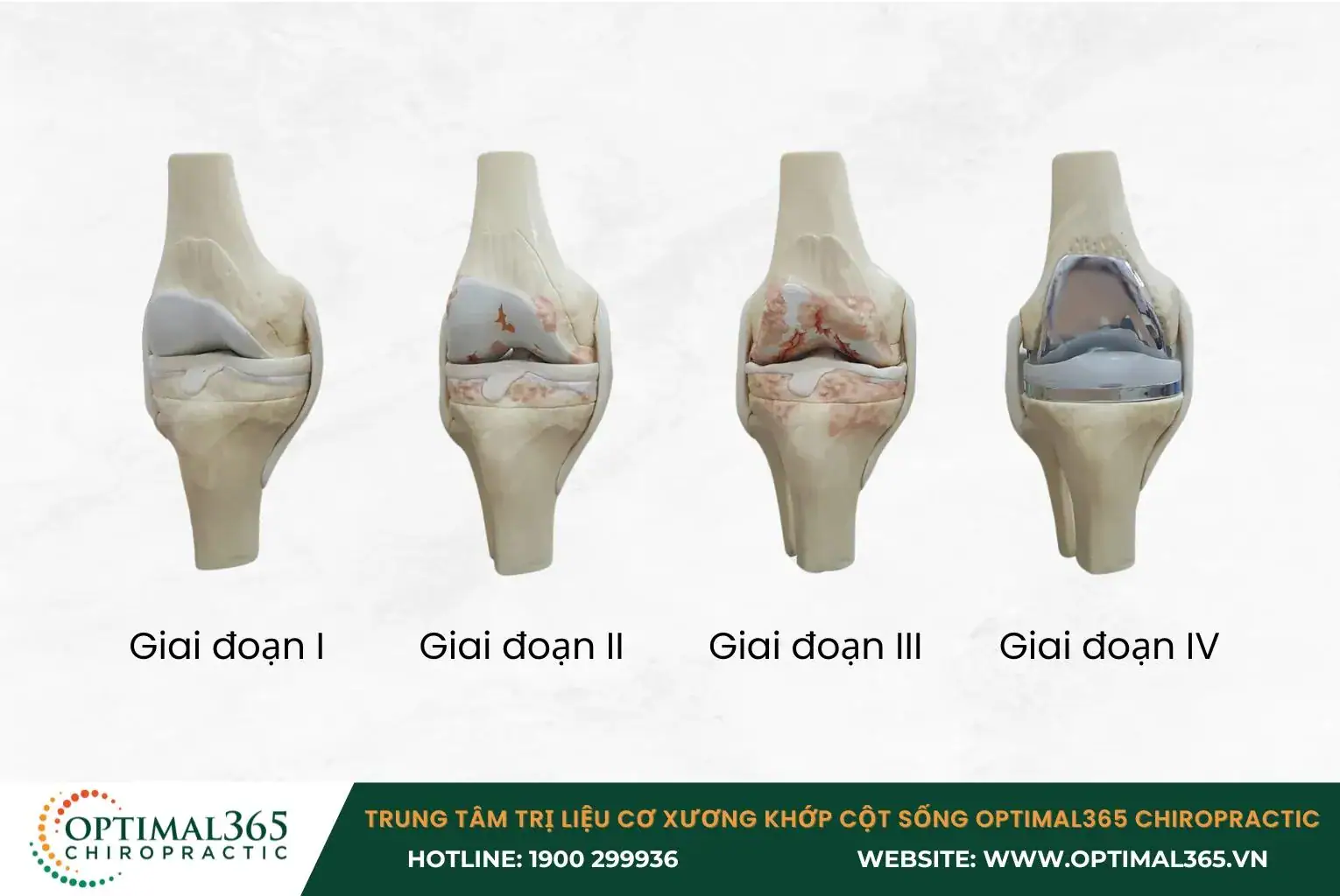 Viêm khớp gối tiến triển chậm qua 4 giai đoạn