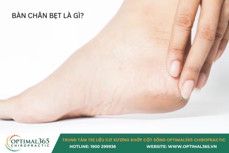 BÀN CHÂN BẸT LÀ GÌ 