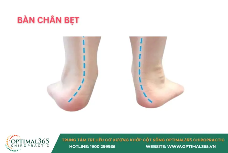 bàn chân bẹt