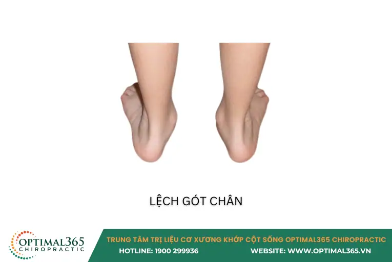 dấu hiệu bàn chân bẹt ở trẻ - lệch gót chân 