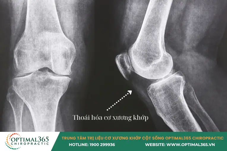 thoái hóa cơ xương khớp