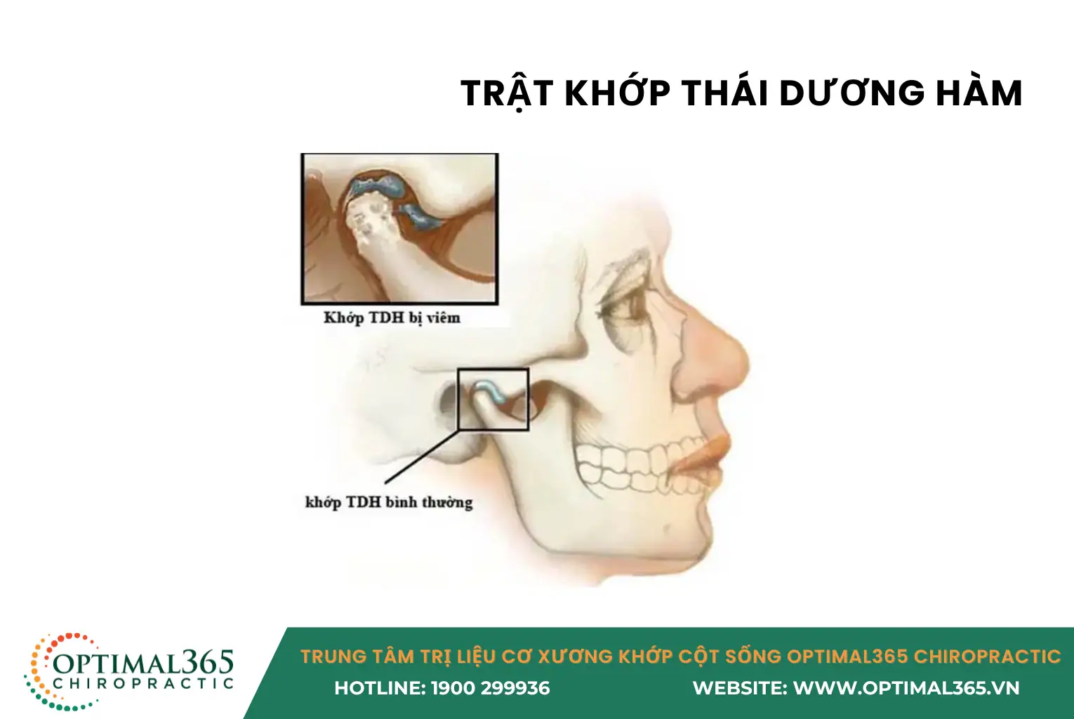 TRẬT KHỚP THÁI DƯƠNG HÀM