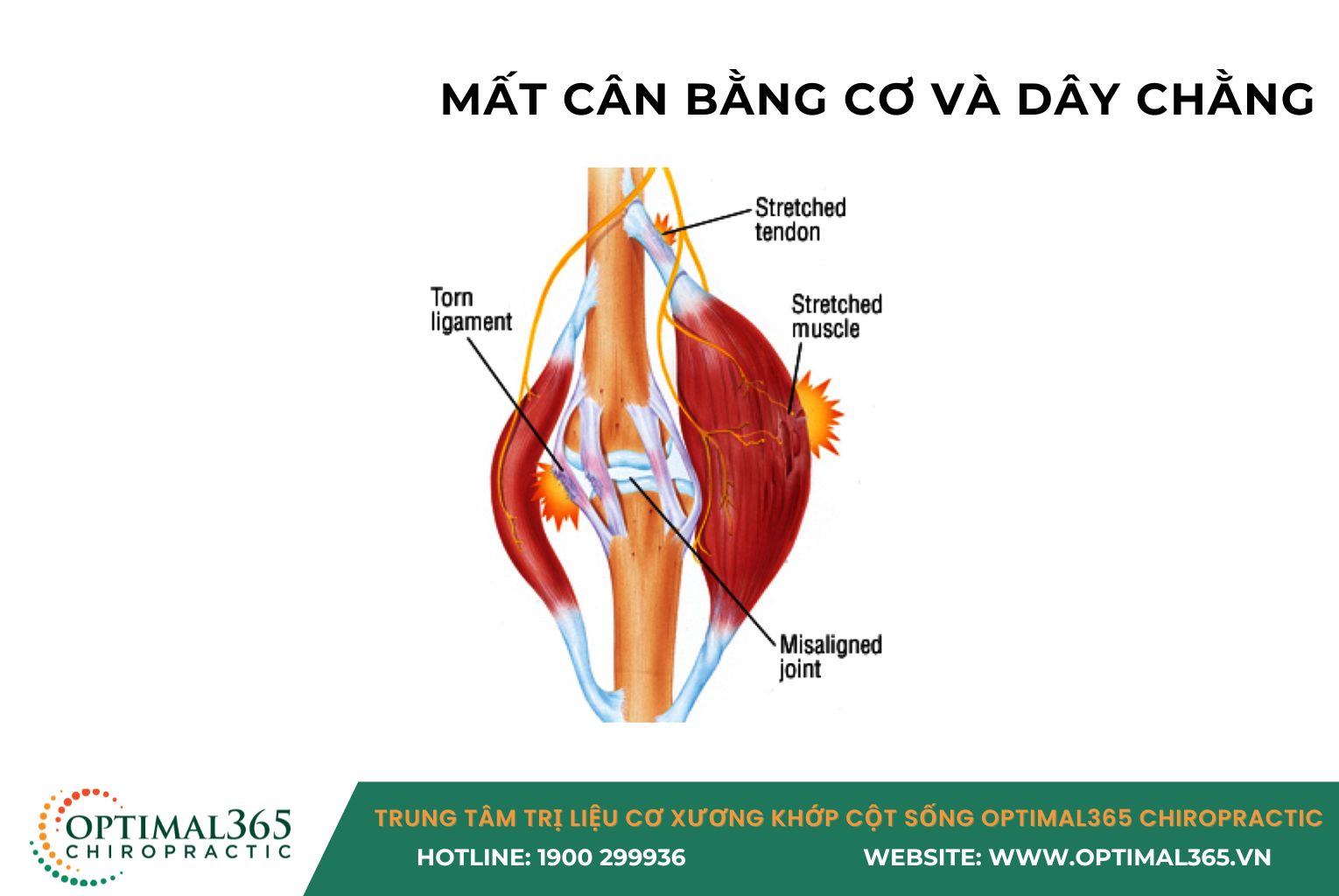 Dáng đi bàn chân bẹt