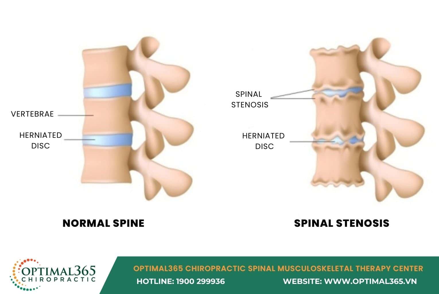 Lumbar spondylosis