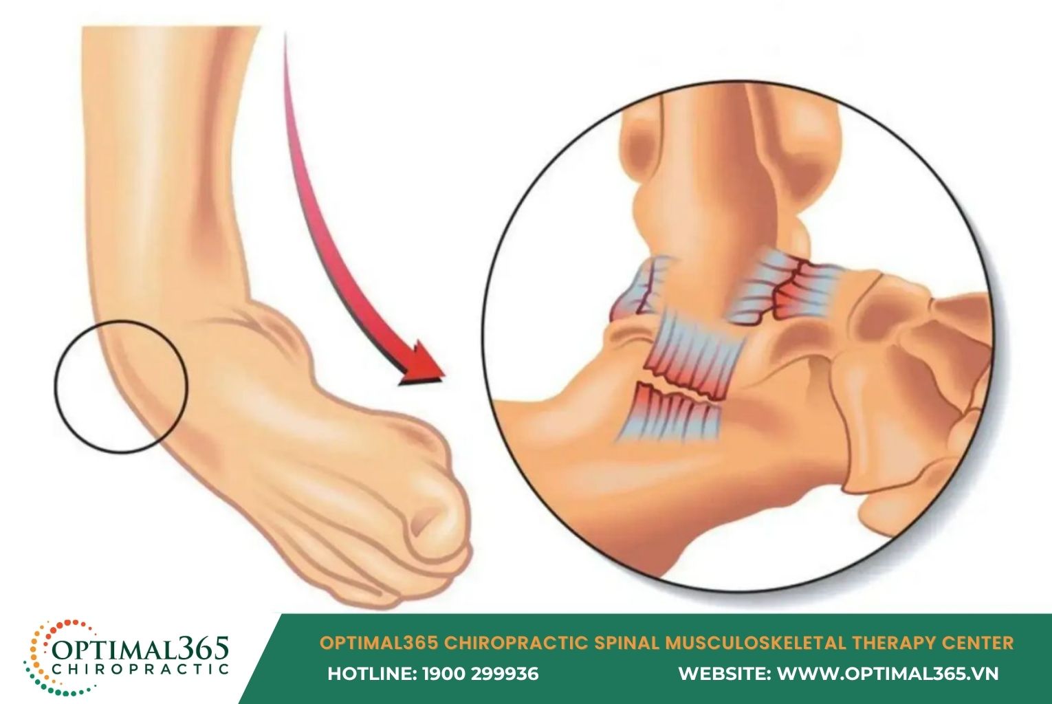 What Causes Ankle Sprains?