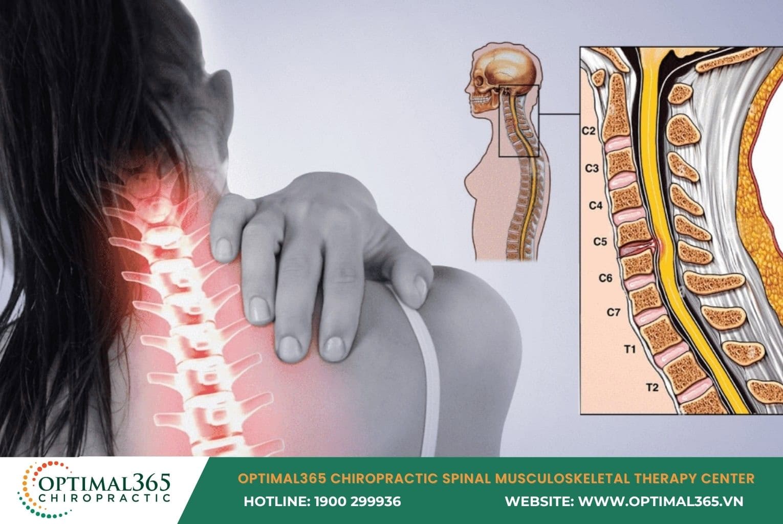 Cervical Herniated Disc