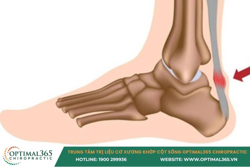 đau hông khi chạy bộ