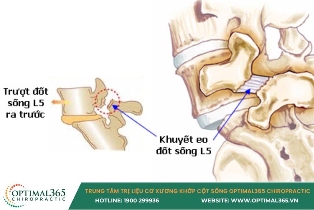 trượt đốt sống 