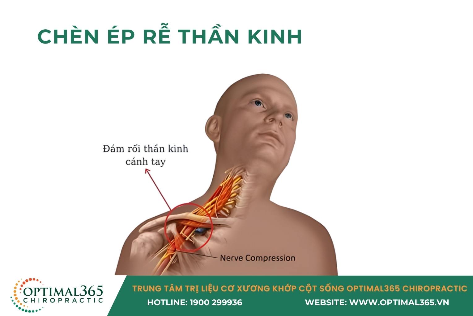 Chèn ép rễ thần kinh gây tê ngón tay út