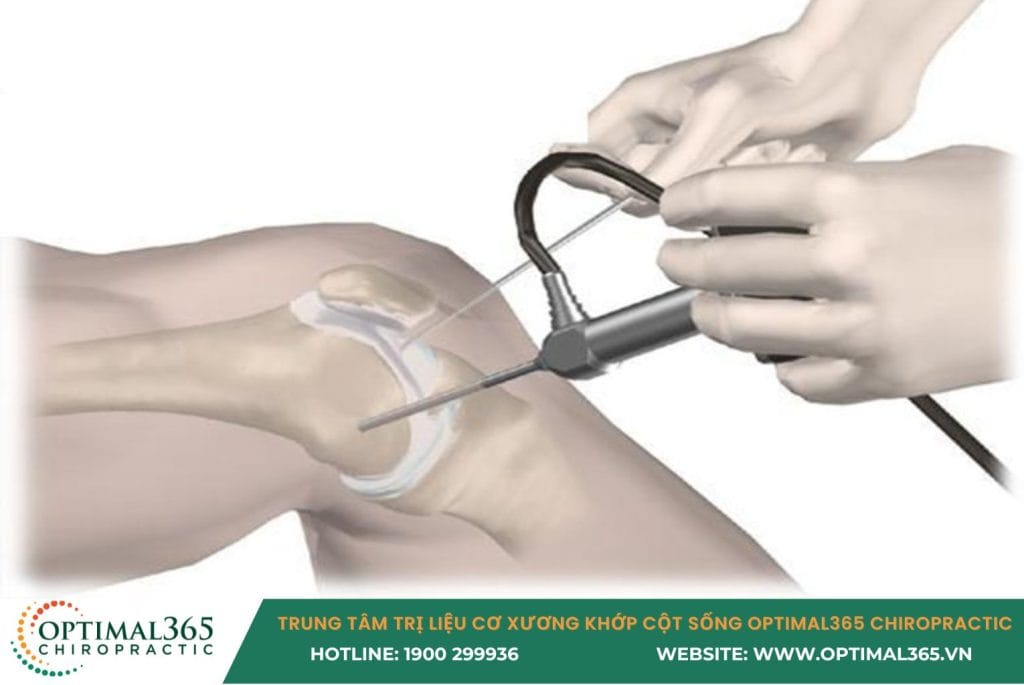 đau đầu gối ở người trẻ