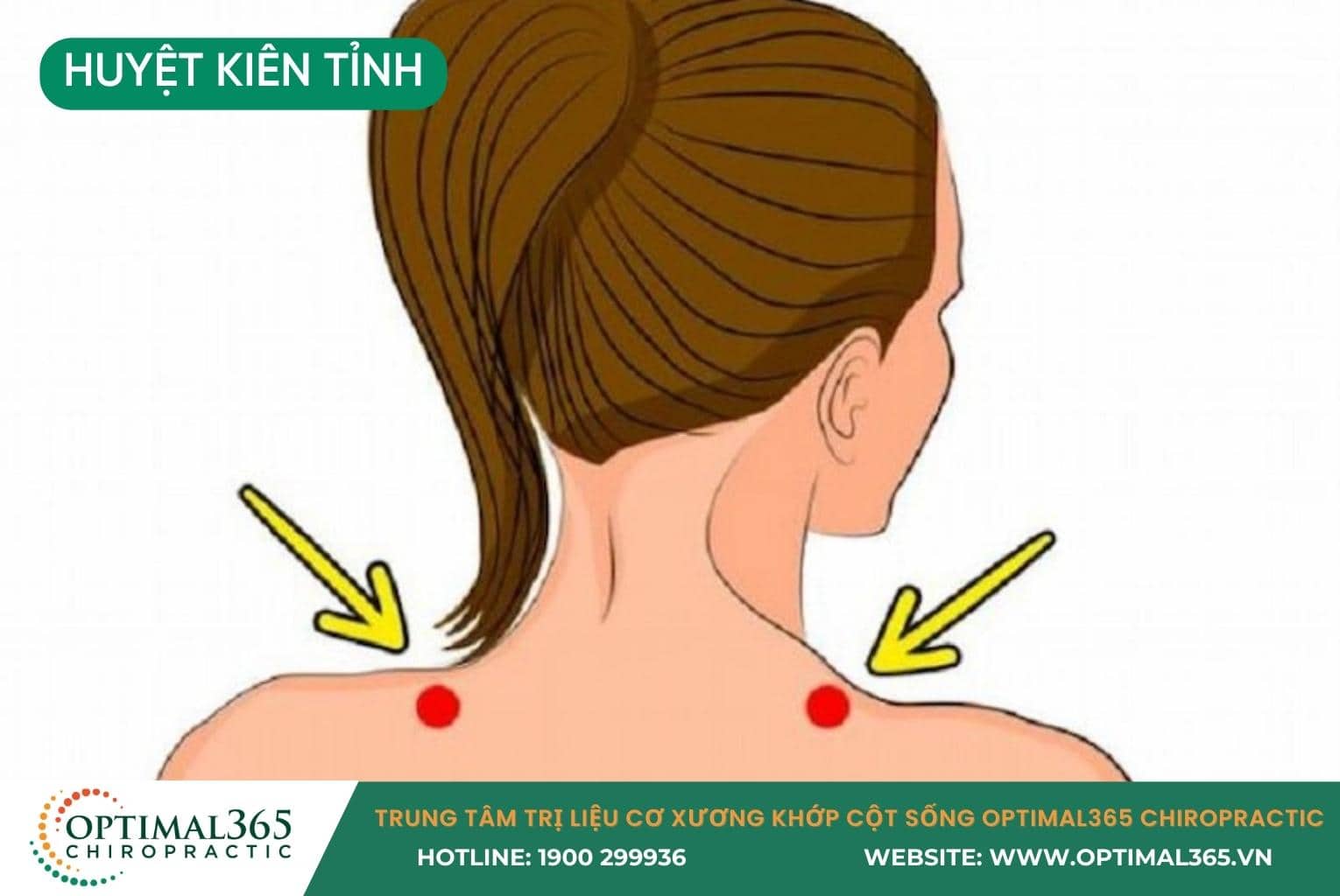 Vị trí huyệt Kiên Tỉnh (GB21) trên đỉnh vai.