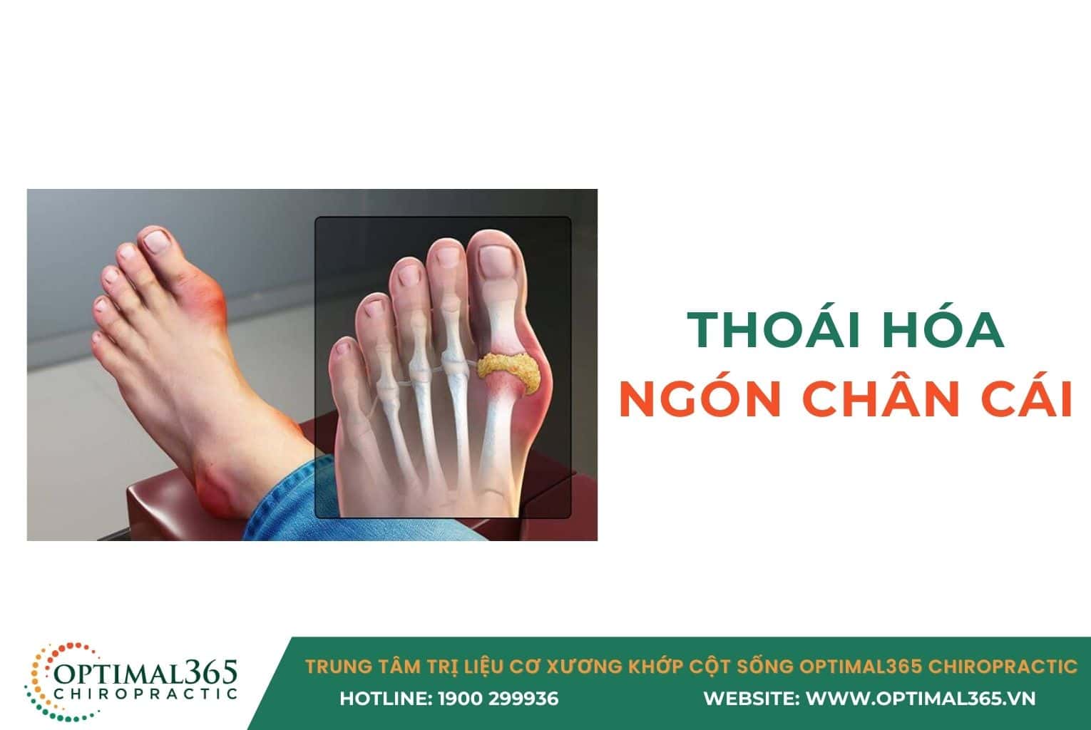 thoái hóa ngón chân cái