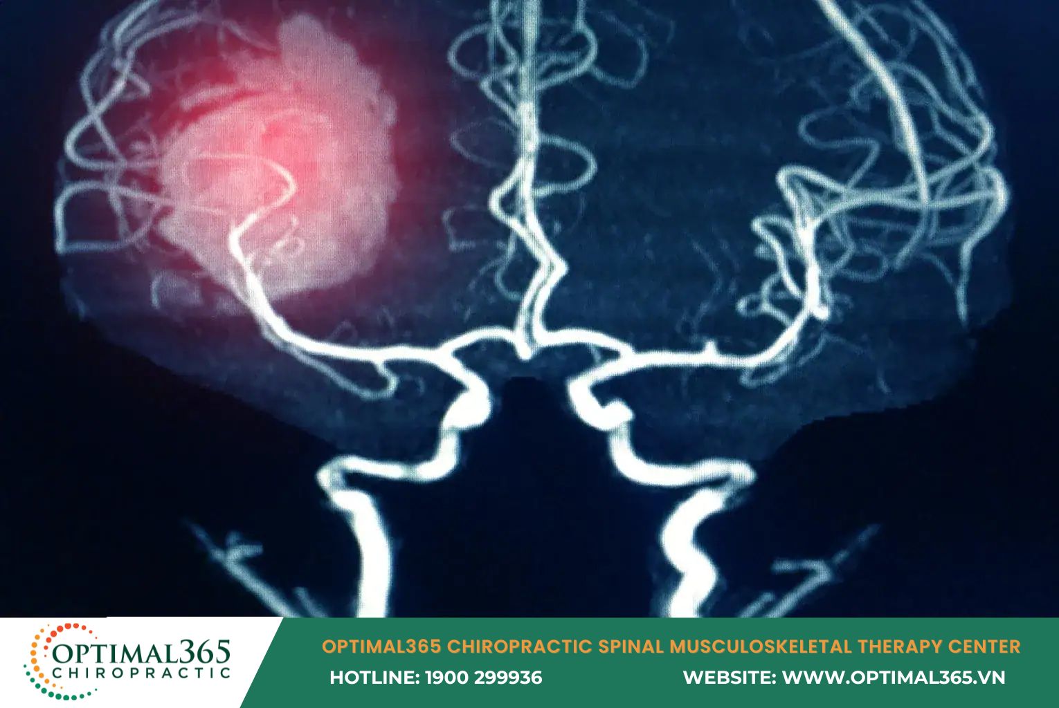 Pain at the Top of the Head Due to Cerebral Hemorrhage
