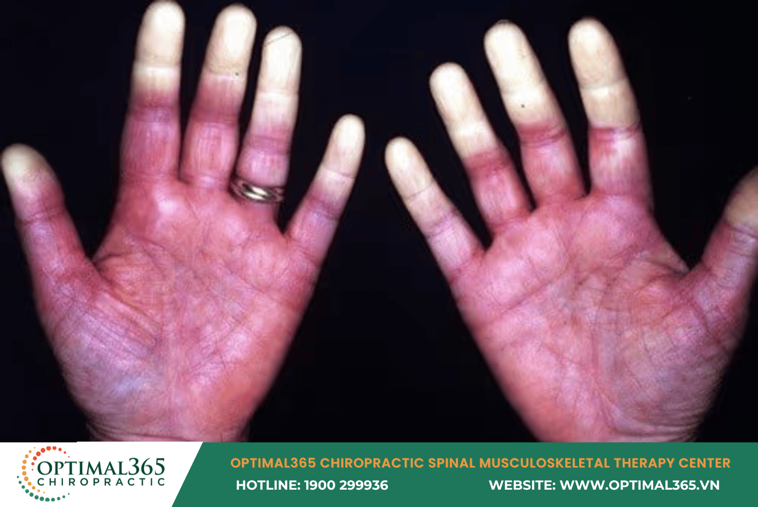 Raynaud’s Phenomenon